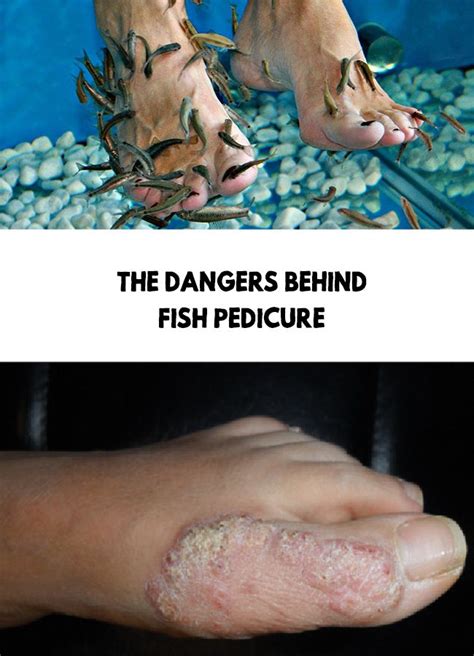 fish pedicure dangers.